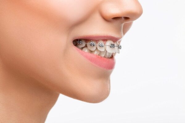 invisalign