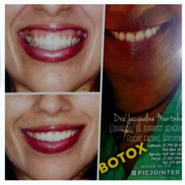Botox Estética
